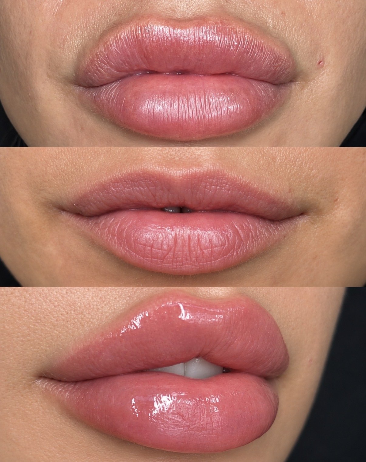 The Benefits of Dissolving and Refilling Lips. Face and Co Belfast, facial architecture and clinical education
